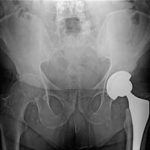 Medical Devices May Evade FDA Scrutiny Before Approval