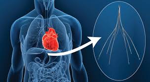 Ivc filter lawsuit