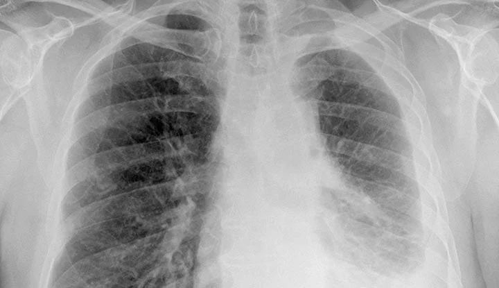 Lawsuit mesothelioma